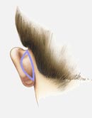 Ear Surgery image2